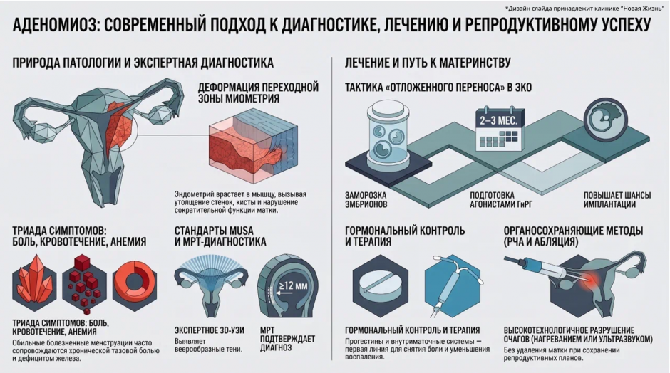 Аденомиоз матки
