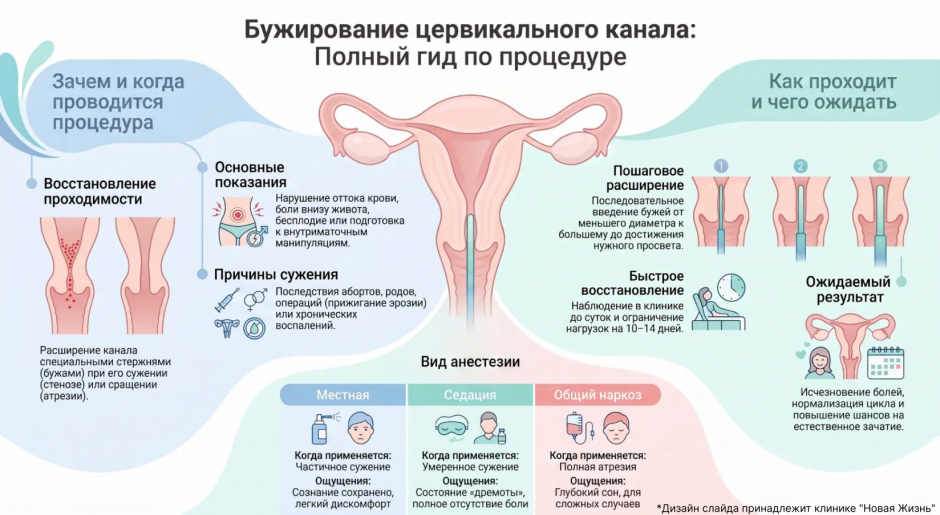 Бужирование цервикального канала